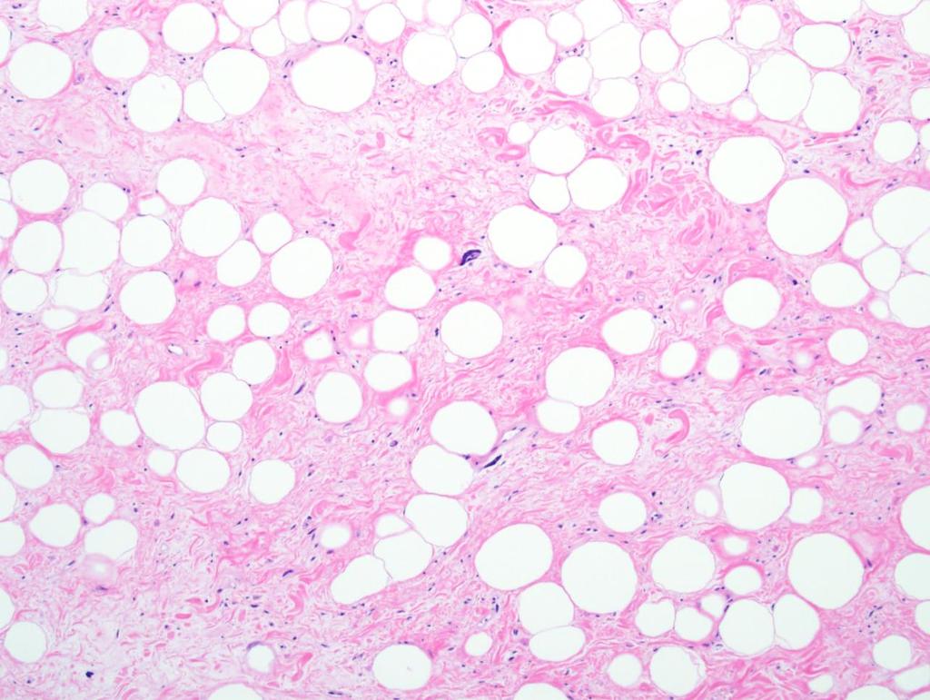 70 year old with retroperitoneal mass Well-differentiated liposarcoma