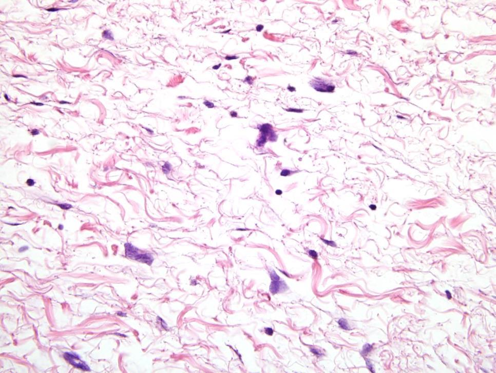 Atypical hyperchromatic stromal cells: Diagnostic cell of atypical