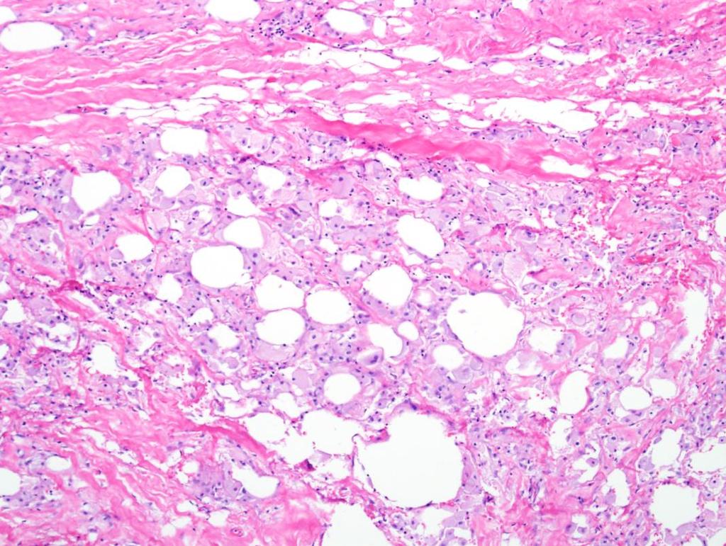 Diagnosis: Lipoma with fat necrosis