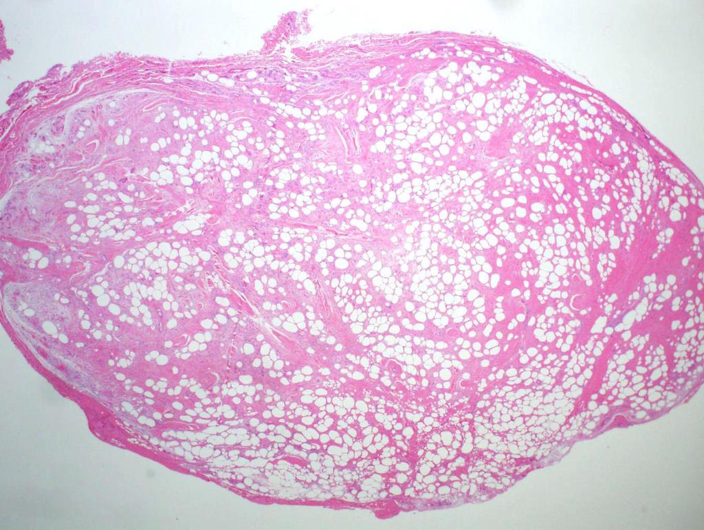 Spindle cell lipoma