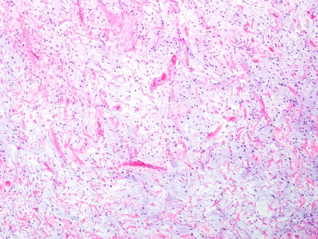Spindle cell lipoma: