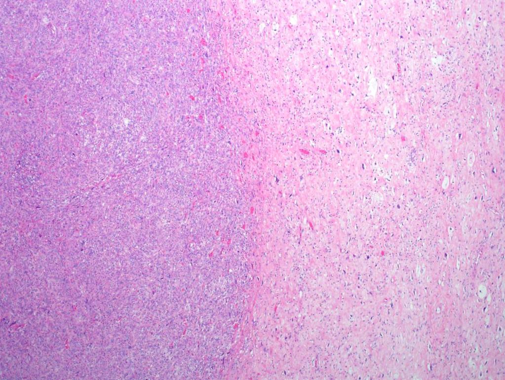 Well-differentiated liposarcoma + High grade