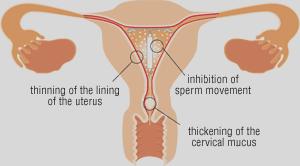 Non-contraceptive Uses of the Levonorgestrel Intrauterine Device Elena Gates, MD http://www.mirena-us.com/pvs1/pri/whatisframe.
