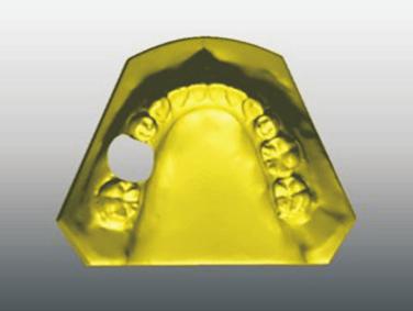 sum of right and left second premolars, excluding the first premolar; the occlusal contact area of the individual teeth, based on maxillary teeth, was calculated as the sum of right and