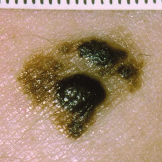 A GUIDE FOR GPS ASSESSING SKIN LESIONS Think ABCDE when assessing pigmented