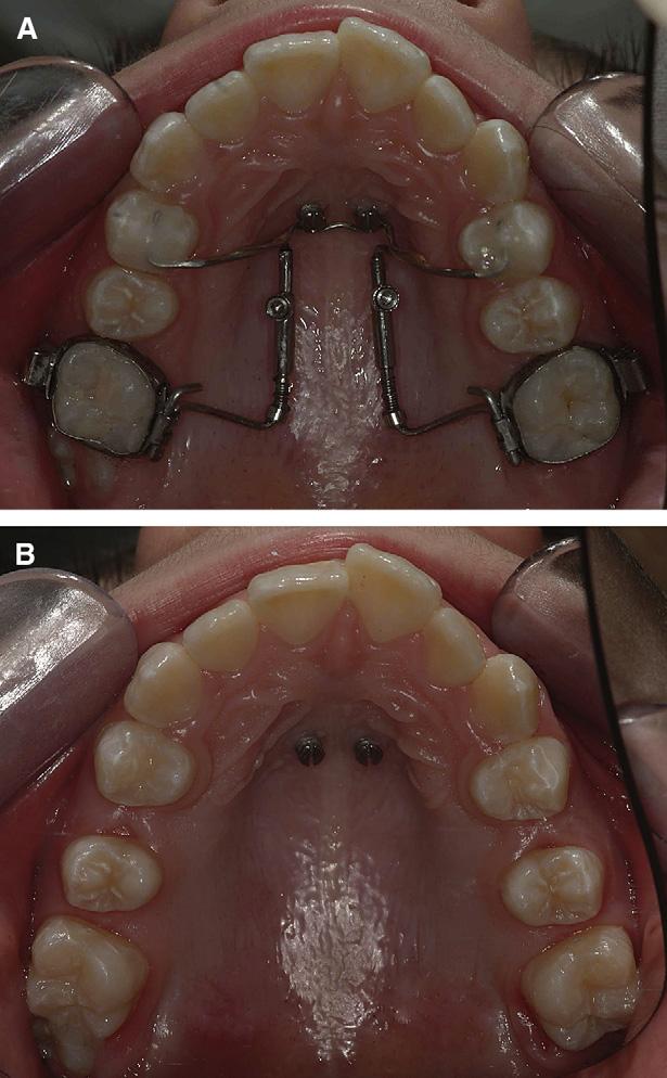 American Journal of Orthodontics and Dentofacial Orthopedics Kinzinger et al 579 Volume 136, Number 4 and, by dispensing with an acrylic button, also achieves better hygiene of the palatal mucosa.
