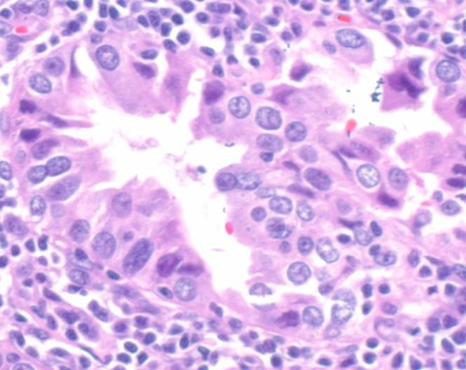 Comparison of original patient tumor and microspheroids used in the ex vivo assays CAF Tumor