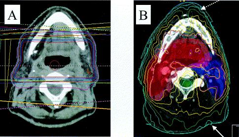 Importance of RVR Dose distribution for conventional beam (A) and IMRT (B) treatment of an oropharyngeal tumour.