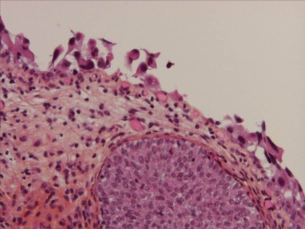 Clinging Cis Pb. of denuded epithelium, or 1 layer Pb.