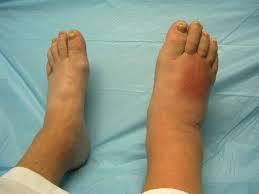Charcot neuroarthopathy Early stage Red, hot,