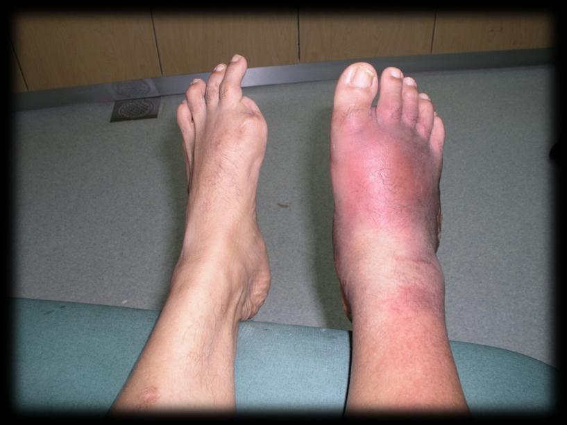 in DM foot, may not have pain Redness may not