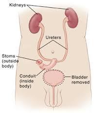 Urinary Diversion Still a very useful