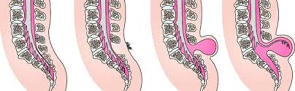 Congenital cord lesions Normal Spina
