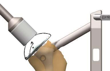 When in contact with the 2 nd cortex, read the measurement and use screw size L + 4 mm. Drill to the 2 nd cortex.