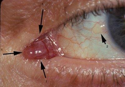 These disorders include "Hay Fever Conjunctivitis," Vernal keratoconjunctivitis