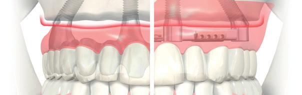 Fixed treatment example Two axial (straight) and two tilted implants (All-on-4) with veneered NobelProcera Implant Bridge
