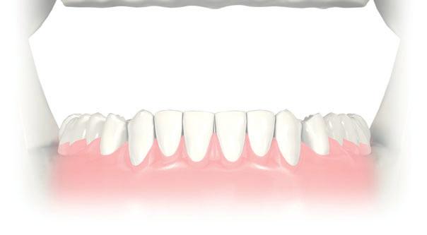 10 Solutions for all edentulous indications Clinical situation 4