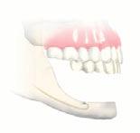 Replacement need mandible