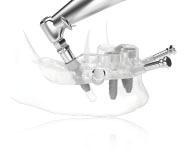 Solutions for all edentulous indications 13 Digital precision with NobelClinician Software Enhanced diagnostics and treatment planning combining 2D and 3D views.