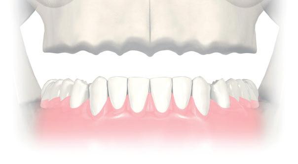 4 Solutions for all edentulous indications Clinical