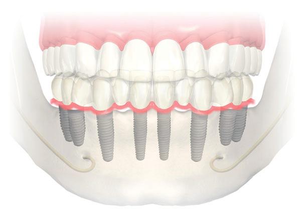 Solutions for all edentulous indications 5 Fixed treatment example Axial (straight) implants with veneered NobelProcera Implant Bridge NobelReplace One implant system for all indications and levels