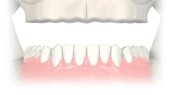 6 Solutions for all edentulous indications Clinical situation 2 mild