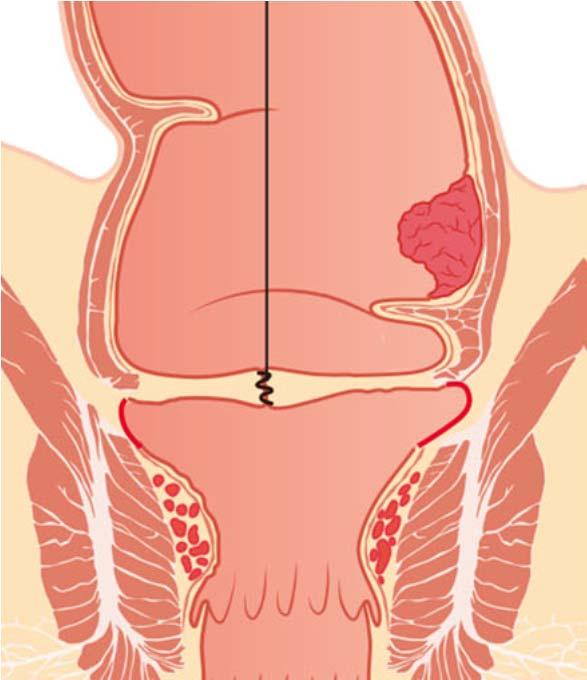 mesorectal excision (TME) short term outcomes in