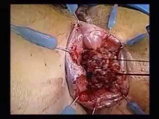 Totally laparoscopic restorative proctectomy with