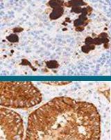 Lung ALK The immunoassay must fit for the purpose: Identify the antibody useful for the specific