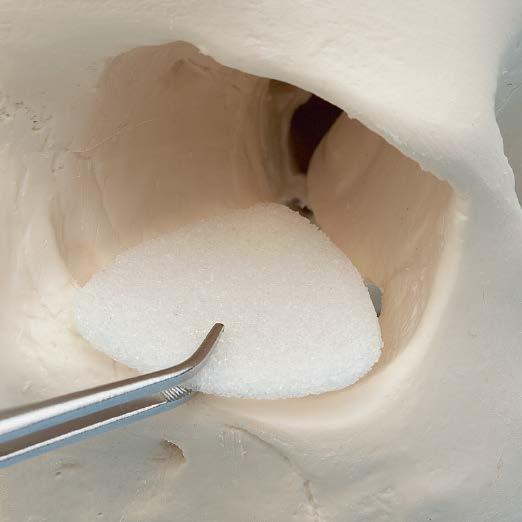 SYNPOR POROUS POLYETHYLENE IMPLANTS SYNPOR Implants are manufactured from an inert, nonabsorbable polymer formulated to contain a network of open and interconnecting pores approximately 100 µm 250 µm