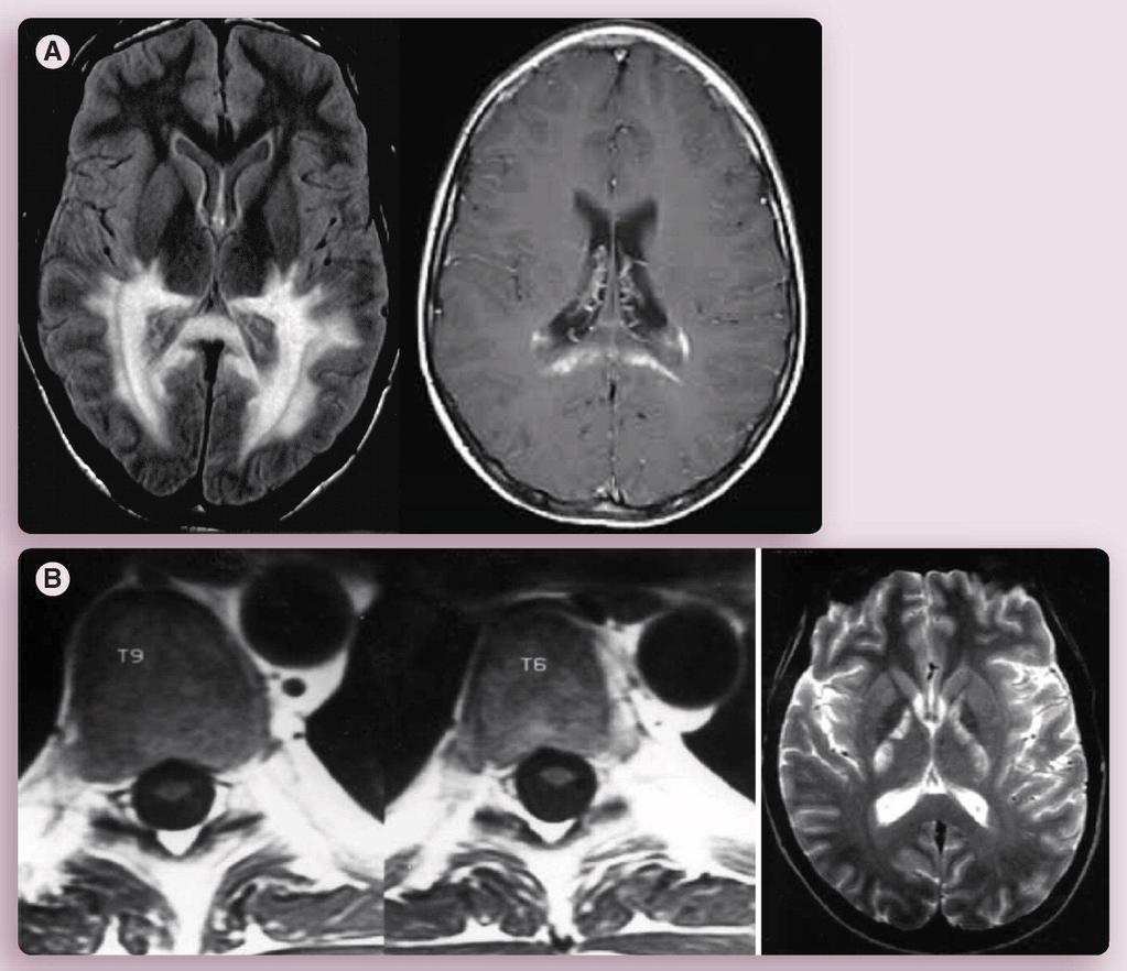 MRI-pattern of X-ALD Expert Review of