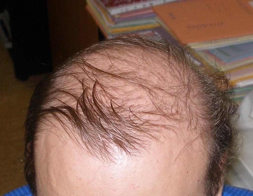 Alopecia in