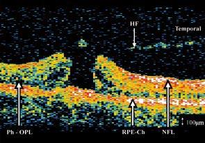 OCT of the vitreoretinal interface in macular hole formation 1093 scanner, Zeiss-Humphrey, San Leandro, CA, USA).