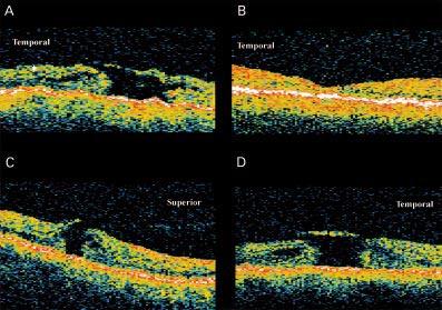 1094 Tanner, Chauhan, Jackson, et al Figure 2 Case 2. Horizontal OCT scan through right fovea with stage 3 macular hole (A).