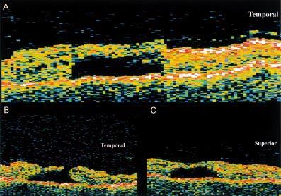 OCT of the vitreoretinal interface in macular hole formation 1095 Figure 3 Case 4. Horizontal OCT scan through centre (A) and just inferior to centre (B) of left fovea with stage 3 FTMH.