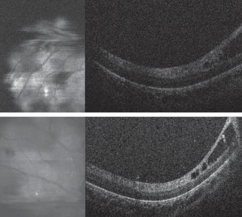 Figure 1. Fundus photograph of 360 of cicatricial stage 3 retinopathy of prematurity with traction at the base in the right () and left () eyes. sedated and, in some cases, paralyzed with vecuronium.