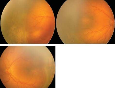 C Figure 3. ctive stage 3 retinopathy of prematurity despite laser treatment. ctive (perfused) stage 3 with mild plus disease in the right () and moderate plus disease in the left () eye can be seen.