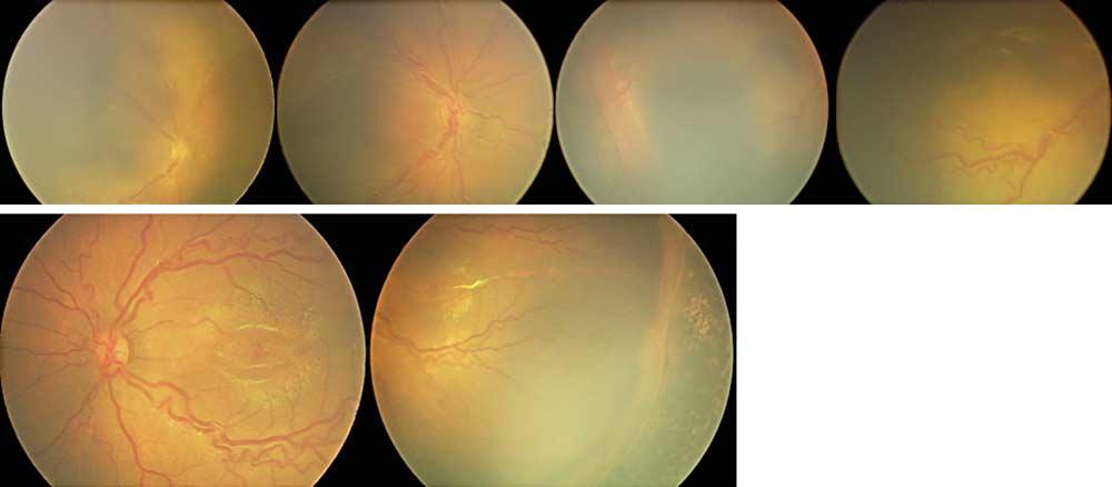 C Figure 7. Exudative retinal detachment and posterior ischemia.