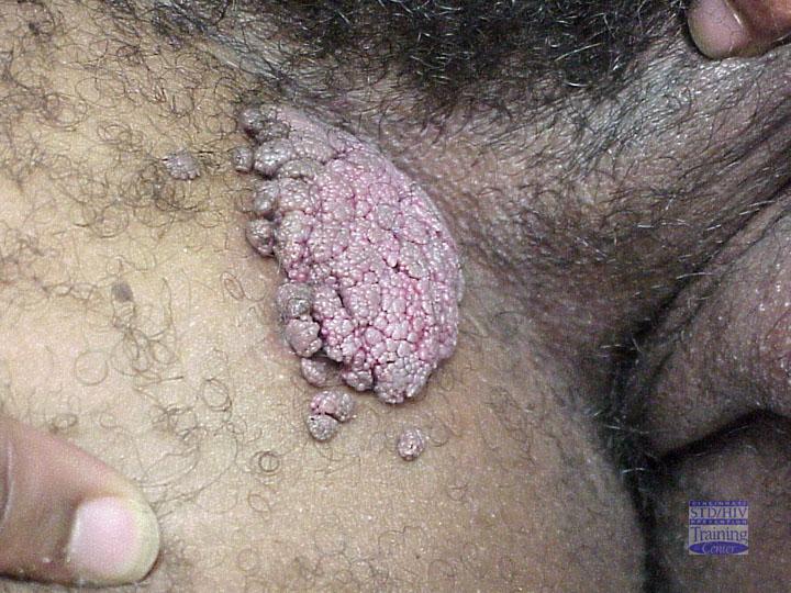 HPV Warts on the