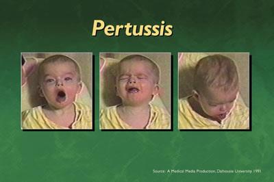 Whooping Cough Also known as Pertussis Outbreaks first described in the 16 th Century