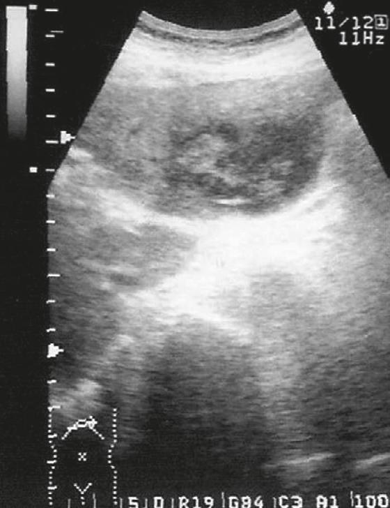 lobe (S8), and which showed as a hypodense lesion on routine abdominal computed tomography (CT) (Figure 1). The liver abscess was confirmed by fine needle aspiration with black-red Figure 1.