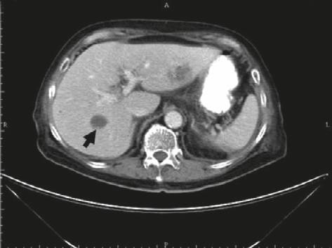 Unfortunately, this patient developed another two episodes of Kp liver abscess in the following year. In May, 2007, she suffered from intermittent fever with chills for 1 week.