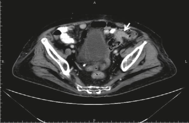 W.H. Hsu, F.J. Yu, C.H. Chuang, et al A B Figure 3. (A) Abdominal computed tomography extended to the pelvic area shows segmental wall thickness over the sigmoid colon (arrow).
