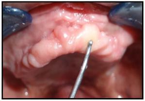 Several Techniques for Management of Flabby Ridge Are a) One part impression technique (Selective perforation tray) b) Controlled lateral pressure technique c) Palatal splinting using a two-part tray