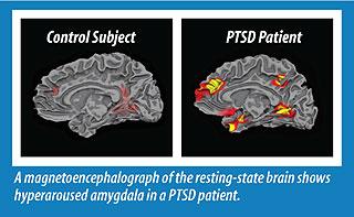 Hyperaroused Amygdala Amygdala Role Alarm Center Fear Drive Center PTSD Hyperarousal