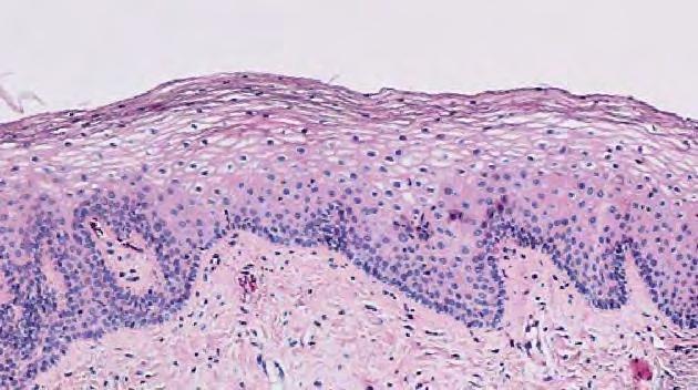Histological studies show neocollagenogenesis and neoangiogenesis processes already visible in histological samples taken at 7 days after one treatment.