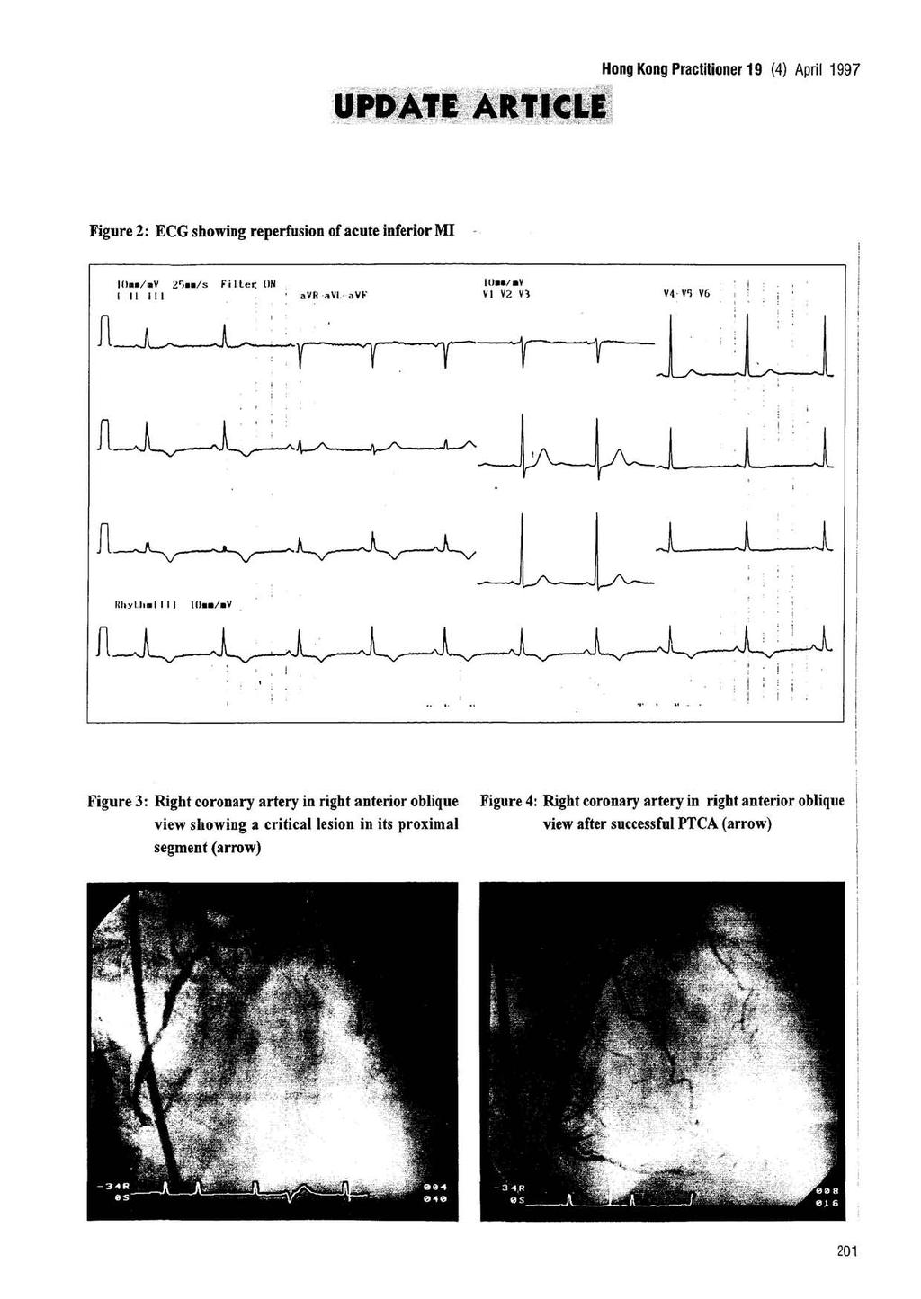 Hong Kong Practitioner 19 (4) April 1997 Figure 2: ECG showing reperfusion of acute inferior M 10m/nV 2 r >mm/s Filter ON ' avr av. avk UM/.