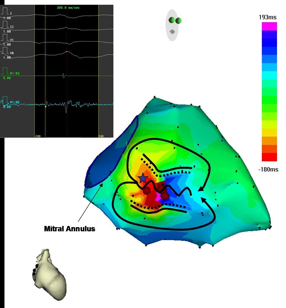 Post-infarct mappable VT Isthmus width = 16±8 mm (6 to 36) Isthmus length = 31±7 mm (18 to 41) de Chillou C et al.