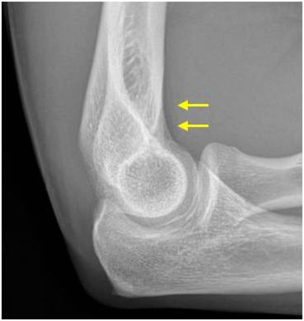 Fig. 7: Normal: Lateral elbow radiograph.