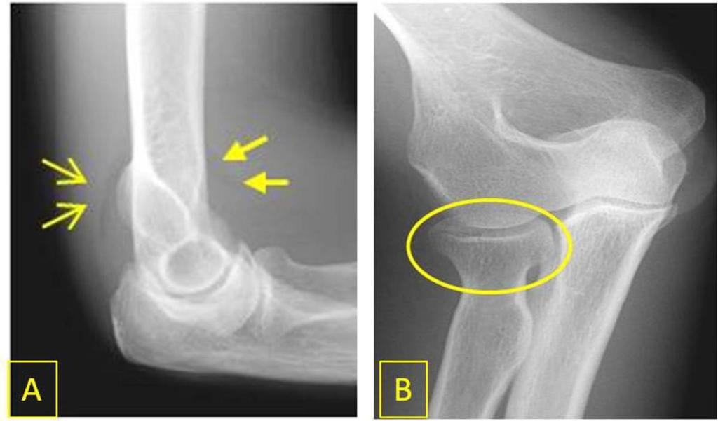 Fig. 8: Lateral elbow radiograph (A) demonstrates abnormal anterior (closed head arrows) and posterior